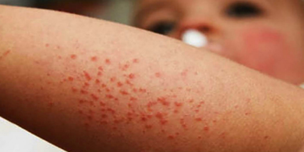 https://assets.gazzettadelsud.it/2019/02/grave-epidemia-morbillo-filippine-970x485.jpg