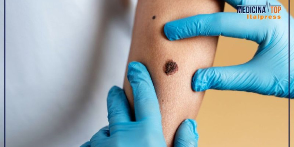 Melanoma bastano da Feedpress.me melanoma bastano 5 scottature a 15 anni per l 80 rischio in più