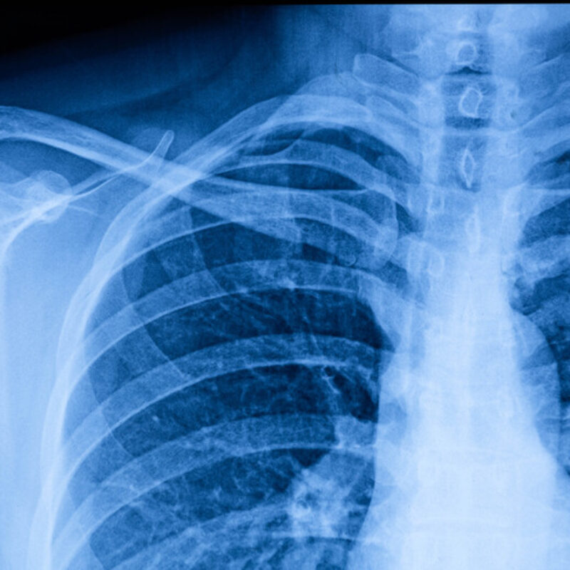 MILANO (ITALPRESS) – Il torace è una parte fondamentale del corpo umano, situata tra il collo e l’addome. E’ composto da una struttura ossea e muscolare che protegge organi vitali quali i polmoni e il cuore, e svolge un ruolo centrale nei processi respiratori e circolatori. Le malattie che possono colpire il torace sono varie