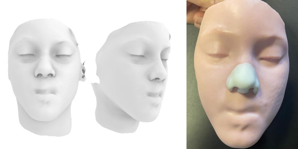 ricostruiti da zero naso e labbro in 3d a un bimbo morso da un animale