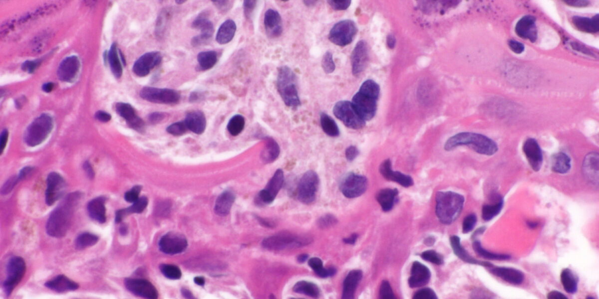 melanoma svolta con il vaccino personalizzato a mrna recidive ridotte del 42 da Gazzettadelsud.it melanoma svolta con il vaccino personalizzato a mrna recidive ridotte del 42